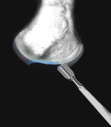 Abrasion