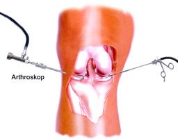 Arthroskopie