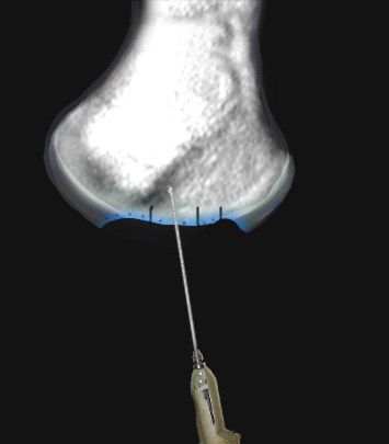 Knochenanbohrung