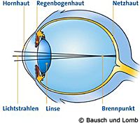 kurzsichtiges Auge