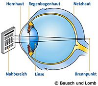 nachlassende Akkomodationsfähigkeit